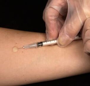 Injection sous-cutanée de testostérone